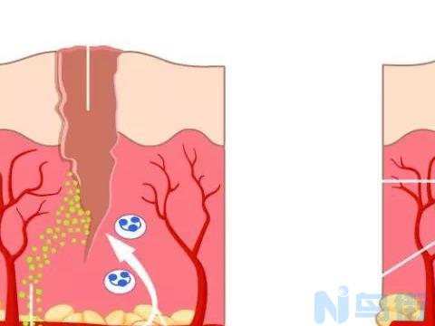 打斗形成的伤口感染