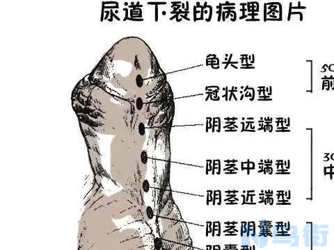 尿道造口后用什么猫砂？